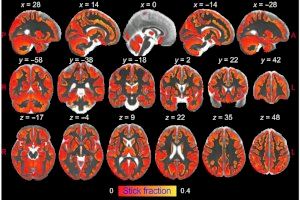 Una ressonància magnètica permet veure la inflamació del cervell ‘in vivo’ per primera vegada