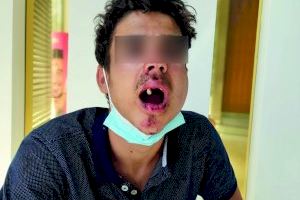 Un joven pierde tres dientes en una brutal paliza a las puertas de una discoteca de Dénia