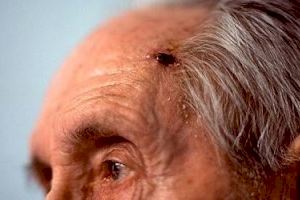 Día Mundial del Melanoma: síntomas, tratamiento e incidencia en ancianos