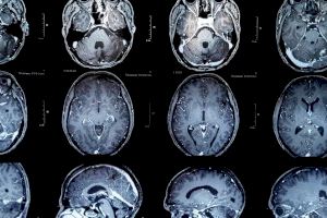 Avance médico: Investigadores valencianos extirpan un tumor cerebral sin dañar al paciente