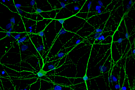 Un estudio del Instituto de Neurociencias UMH CSIC revela la distribución de receptores de NMDA en cerebros de individuos con alzhéimer